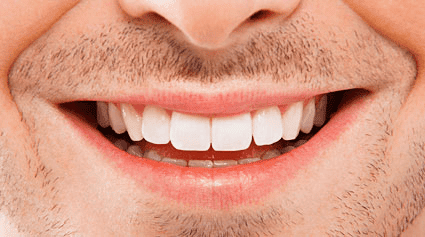 mitos y verdades del blanqueamiento dental