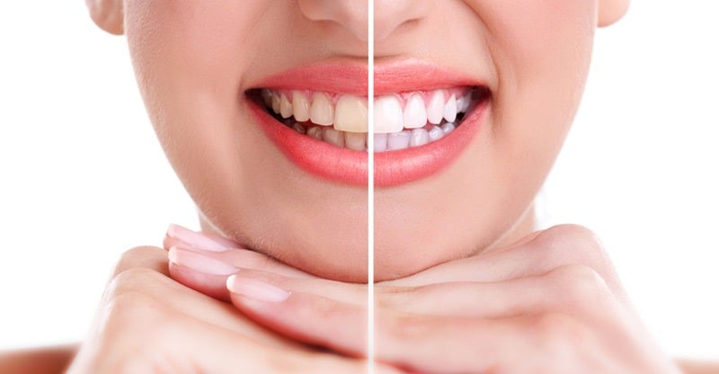 Blanqueamiento dental en C.O.V.