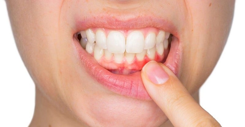 Periodonditis como prevenirla