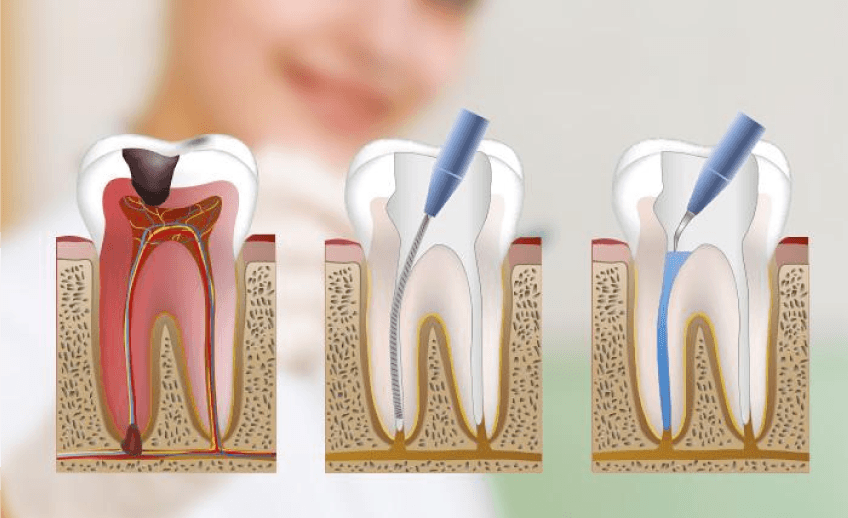 Tipos de endodoncia