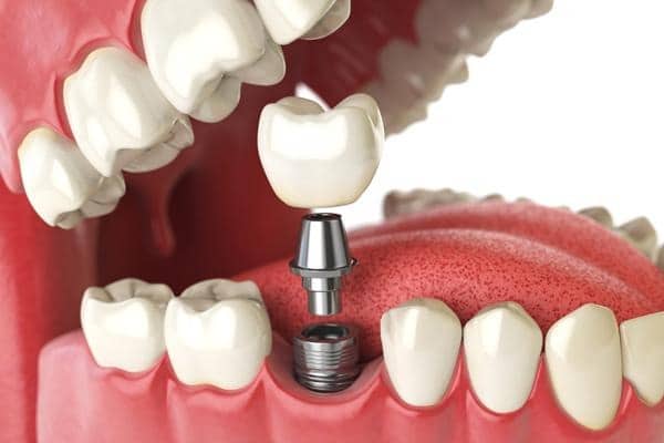 Prótesis dentales - Clínica cov