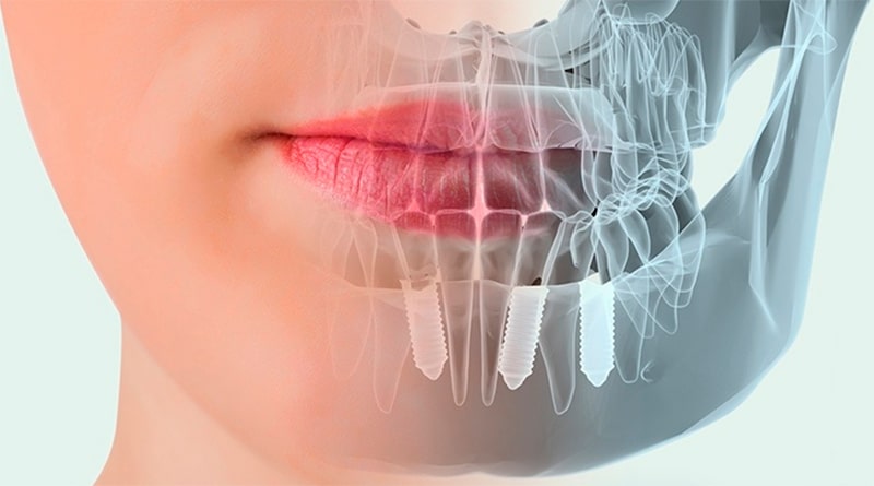 Implantes Dentales Cuidado