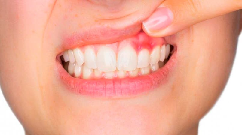 Periodoncia
