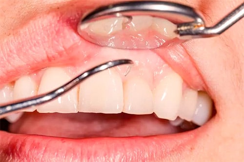 Tratamiento Periodontal