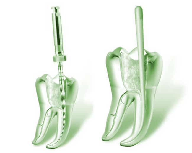Endodoncia