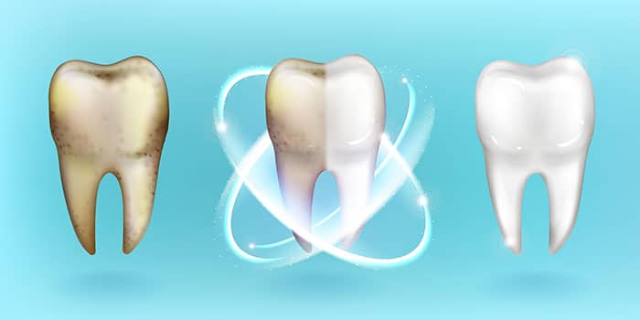 Blanqueamiento Dental en Valencia