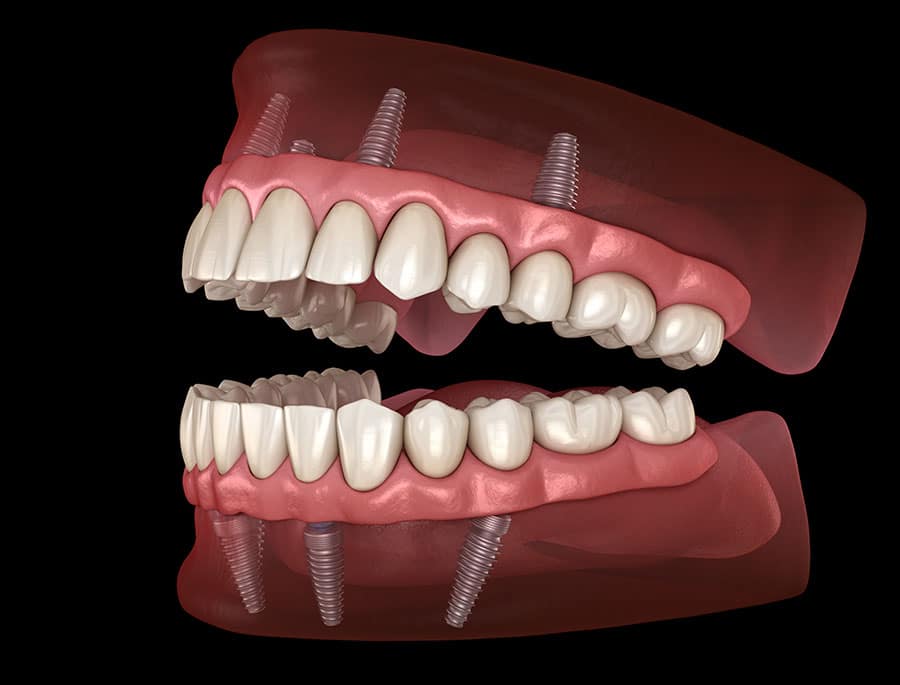 Técnica Implantes All On Four